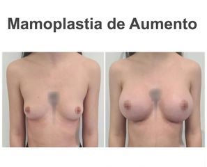 Aumento de pecho - Instituto de Cirugía Plástica y Reconstructiva del Mediterráneo