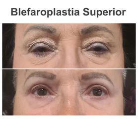 Blefaroplastia - Instituto de Cirugía Plástica y Reconstructiva del Mediterráneo
