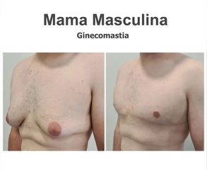 Ginecomastia - Instituto de Cirugía Plástica y Reconstructiva del Mediterráneo