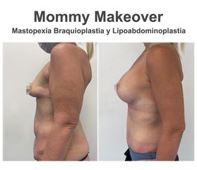 Lipoescultura - Instituto de Cirugía Plástica y Reconstructiva del Mediterráneo