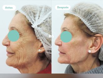 Rejuvenecimiento facial antes y después - 876790