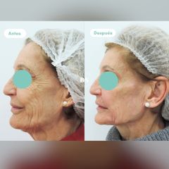 antes y despues - Doctores BenSan
