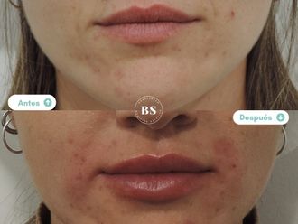 Aumento labios antes y después - 876791