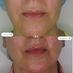 Inductores o Estimuladores de Colágeno - Doctores BenSan