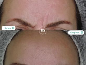 Rejuvenecimiento facial antes y después - 876793