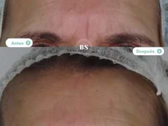 Rejuvenecimiento facial antes y después - 876794