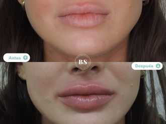 Aumento labios antes y después - 876795