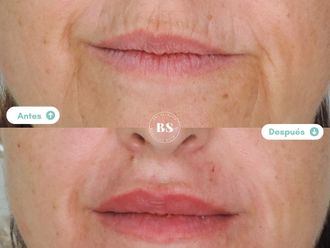 Rejuvenecimiento facial antes y después - 876796