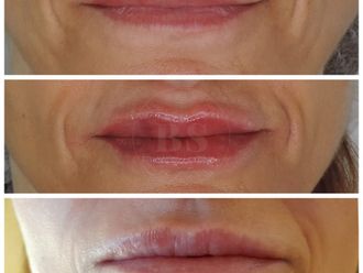Aumento labios antes y después - 876797