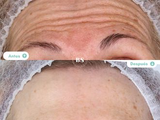 Rejuvenecimiento facial antes y después - 876798