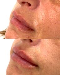 Aumento de labios - Clínica Image