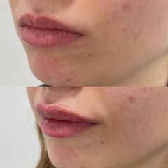 Aumento de labios - Clínica Image