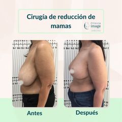 Reducción senos - Clínica Image