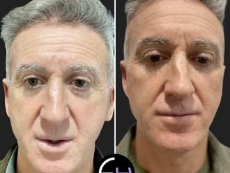 Rejuvenecimiento facial antes y después - 878893