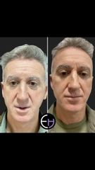 Dr. Eduardo Higbi - Rejuvenecimiento facial