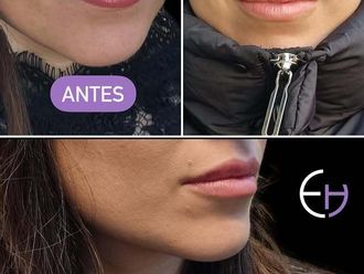 Aumento labios antes y después - 878894