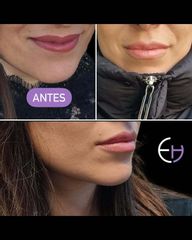 Dr. Eduardo Higbi - Aumento de labios