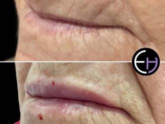 Aumento labios antes y después - 878896