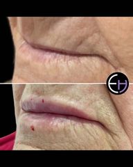 Dr. Eduardo Higbi - Aumento de labios