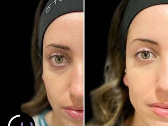 Eliminación ojeras antes y después - 878897