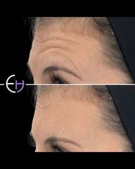 Dr. Eduardo Higbi - Rejuvenecimiento facial