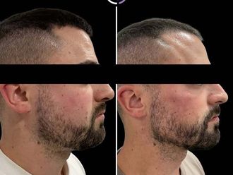 Marcación mandibular antes y después - 878903