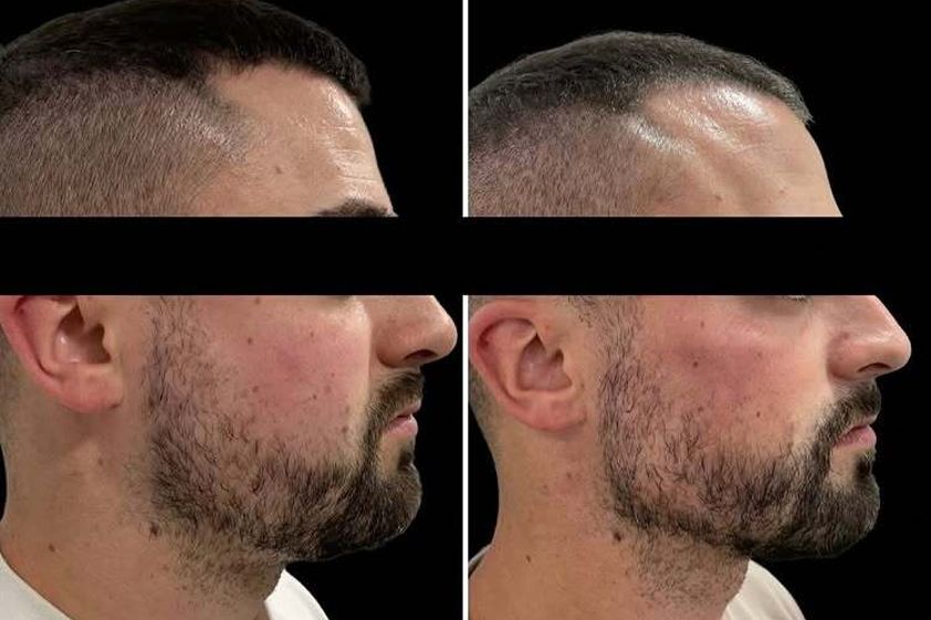 Marcación mandibular antes y después - 878903