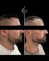 Dr. Eduardo Higbi - Marcación mandibular