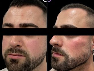 Marcación mandibular antes y después - 878904