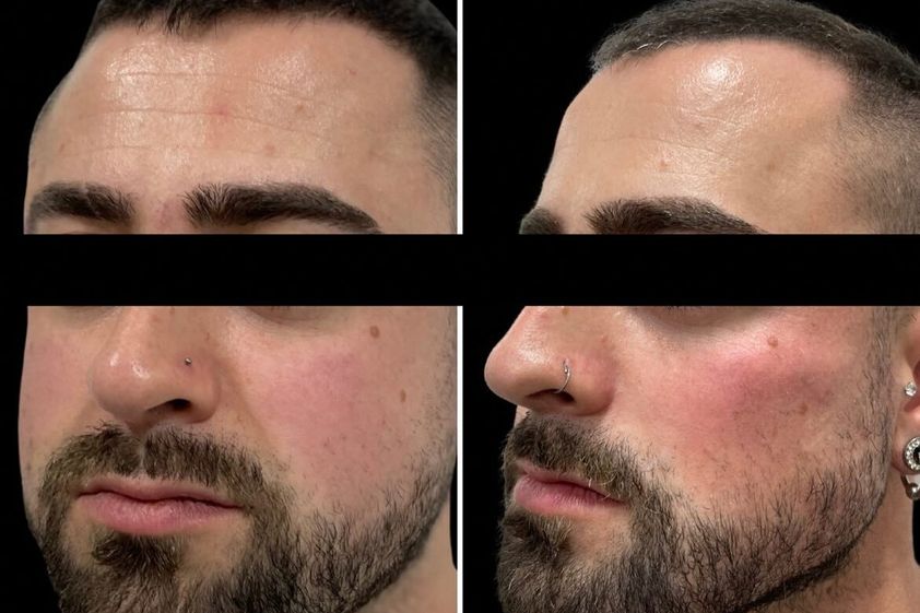 Marcación mandibular antes y después - 878904