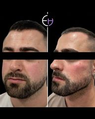 Dr. Eduardo Higbi - Marcación mandibular