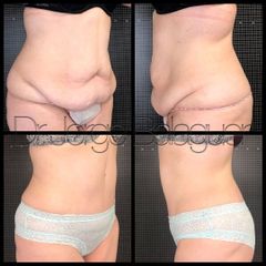 Abdominoplastia - Clinica Dr Balaguer