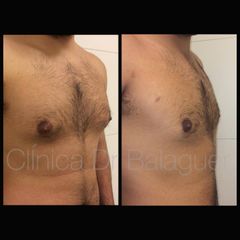 Ginecomastia - Clinica Dr Balaguer