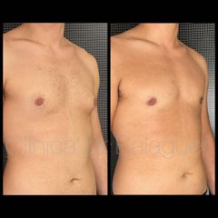 Ginecomastia - Clinica Dr Balaguer