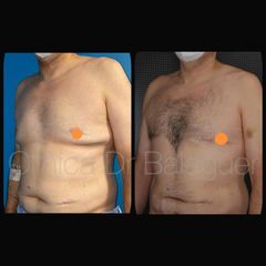 Ginecomastia - Clinica Dr Balaguer