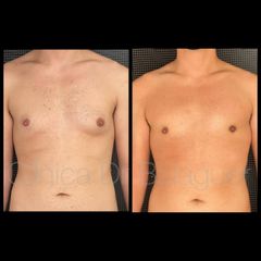 Ginecomastia - Clinica Dr Balaguer