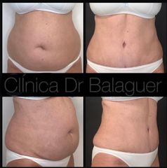 Abdominoplastia - Clinica Dr Balaguer