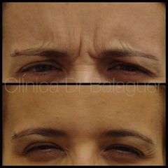 Rellenos faciales - Clinica Dr Balaguer