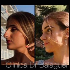 Rinoplastia - Clinica Dr Balaguer