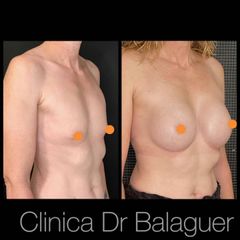 Aumento de pecho - Clinica Dr Balaguer