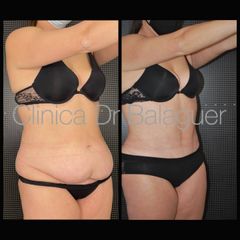 Abdominoplastia - Clinica Dr Balaguer