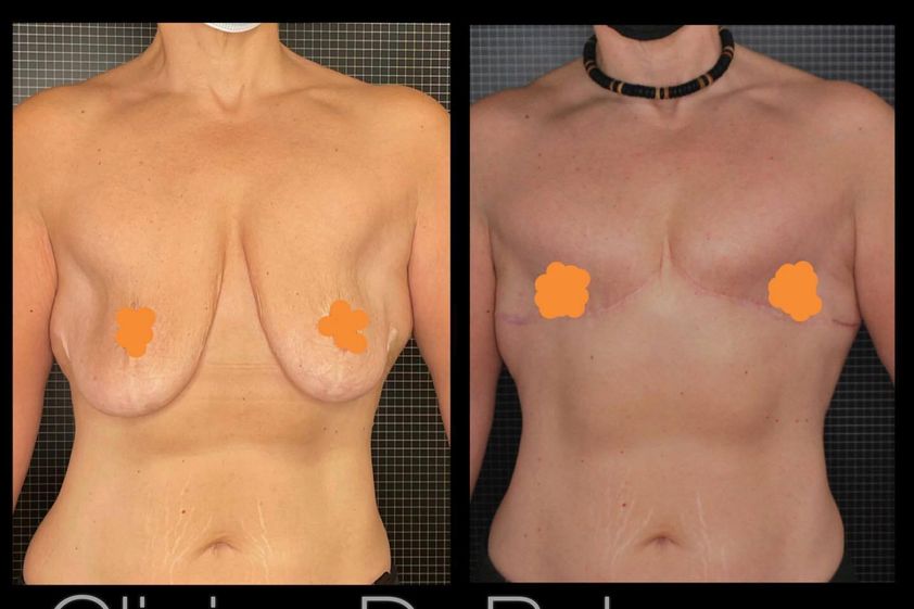 Cambio de sexo antes y después - 847716