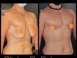 Cambio de sexo antes y después - 847718