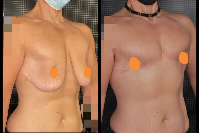 Cambio de sexo antes y después - 847718