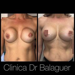 Secuela mamoplastia - Clinica Dr Balaguer