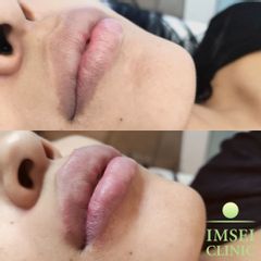 Aumento de labios - IMSEI CLINIC