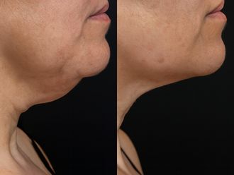 Liposucción de papada antes y después - 879947