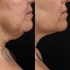 Lipopapada