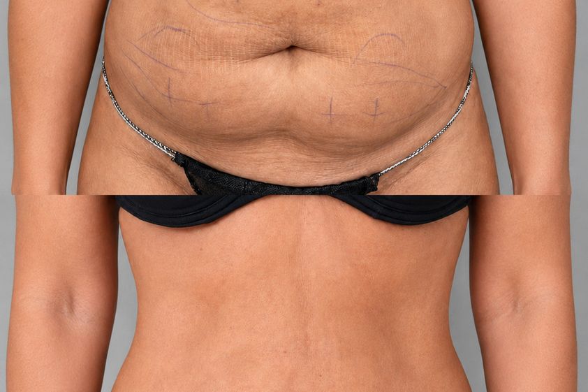 Lipoláser antes y después - 879948