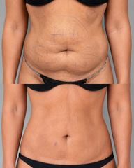 Lipolaser